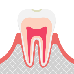 虫歯の前兆