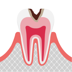 中度の虫歯