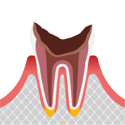 最重度の虫歯