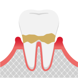 軽度の歯周病