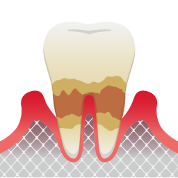 中程度の歯周病